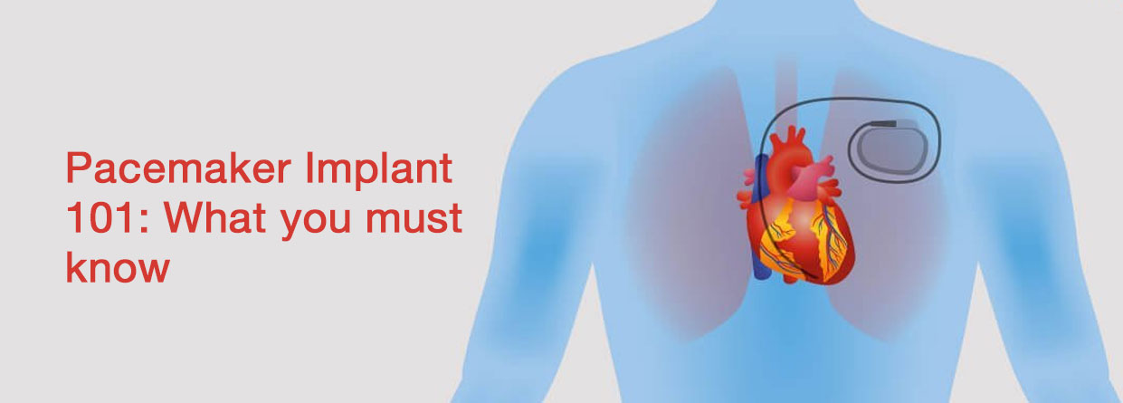 Pacemaker Implant 101: What you must know
